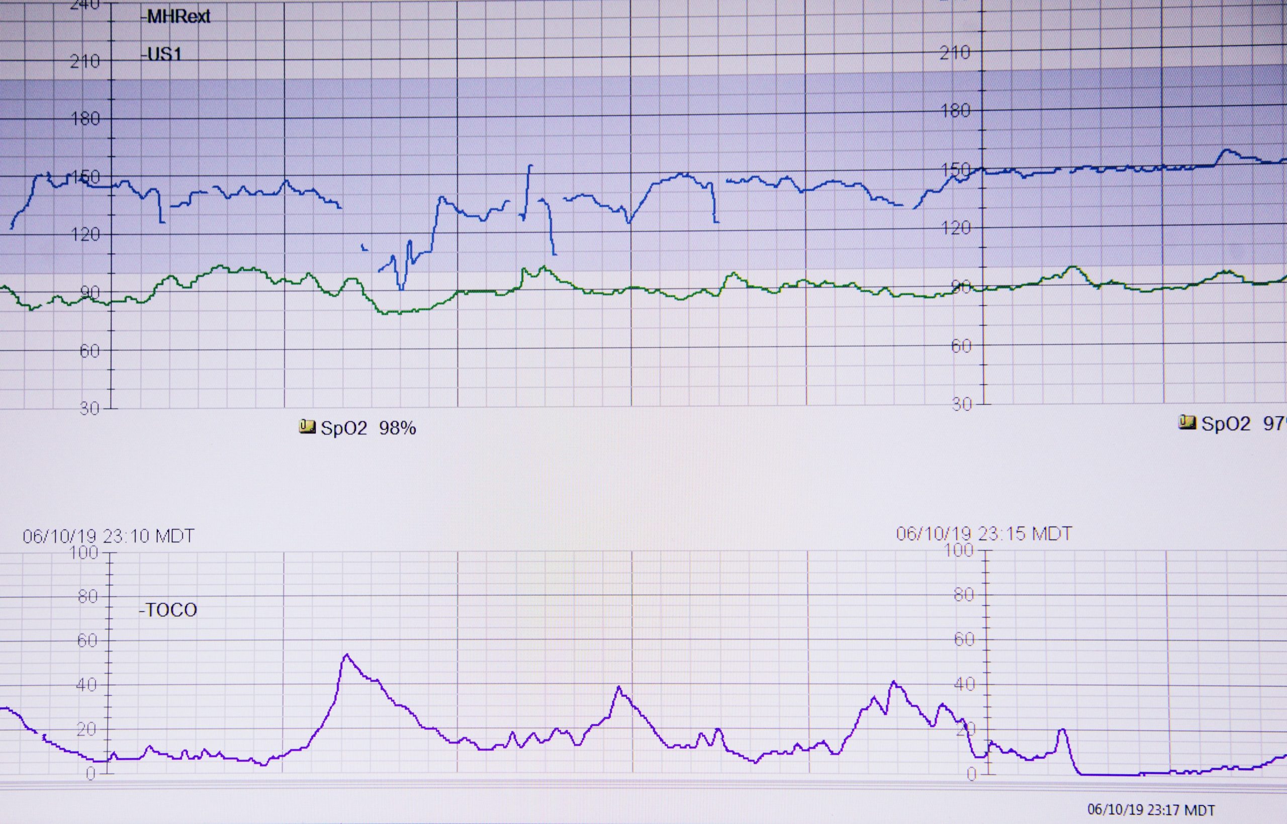 Chart showing improved streaming metrics post-CDN optimization